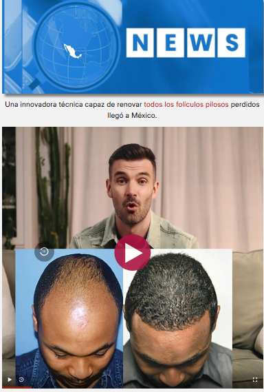 Video Explicativo Calvicie